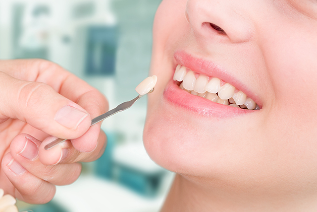 perfect smile veneer 